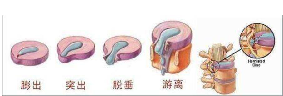 腰椎间盘突出手术还是保守治疗好,腰椎间盘突出10mm还能保守治疗吗