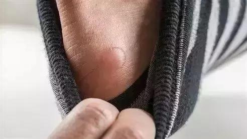 跑步跑到脚趾甲盖里面有水泡图片,跑步脚上出现黑趾甲该怎么处理