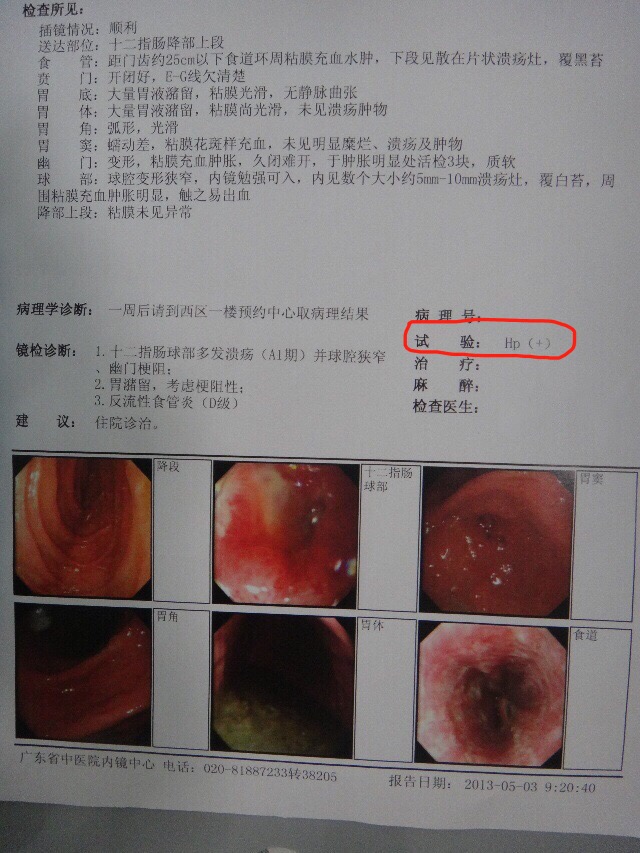 幽门螺旋杆菌青梅精,幽门螺旋杆菌