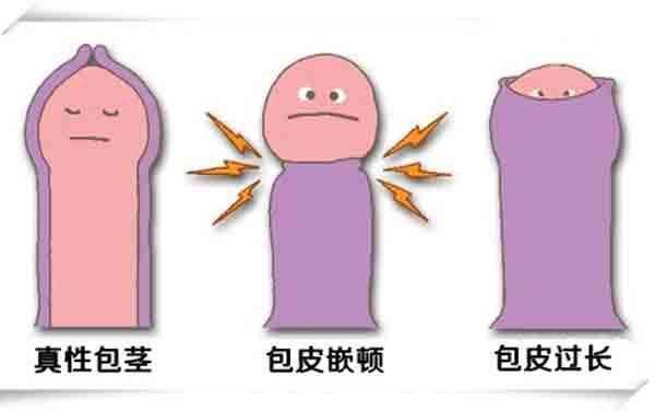 男生要不要割包皮,包皮到底要不要割了