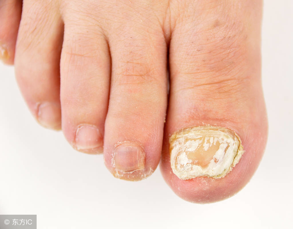 灰指甲是在霉菌交互情况下感染的，怎么治疗有效呢