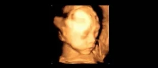 为什么我的彩超看不清宝宝,为什么我的四维彩超看不见脑门