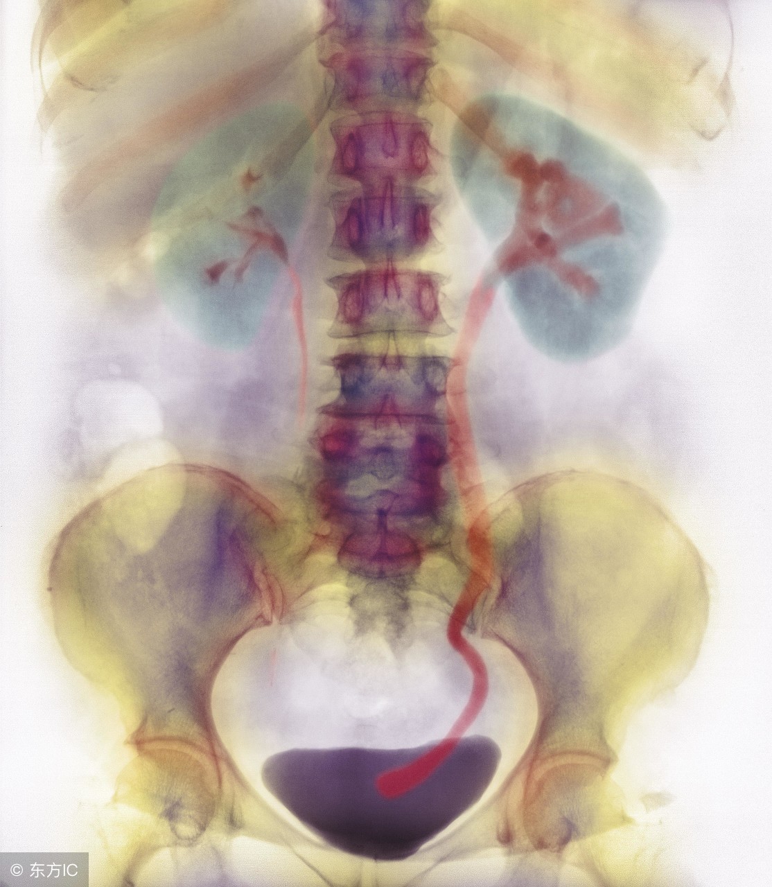 输尿管结石激光治疗有副作用吗,输尿管下段结石能用激光治疗吗