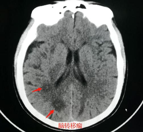 肺癌脑部转移还有脑血栓,脑梗查出肺结节怀疑肺癌