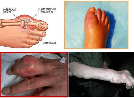 抗痛风药物的总结及用药禁忌