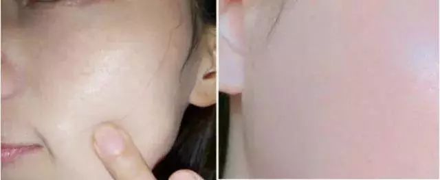 好物去黑头祛痘,去黑头粉刺面霜