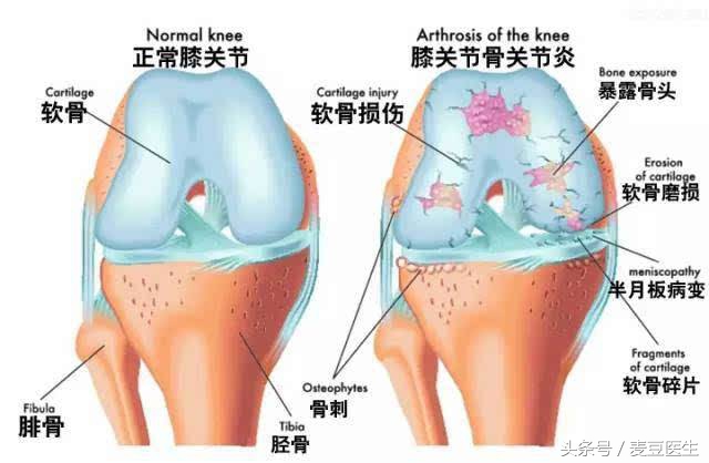 膝盖疼咯吱响是什么原因,膝盖疼一动咯吱咯吱的响怎么回事