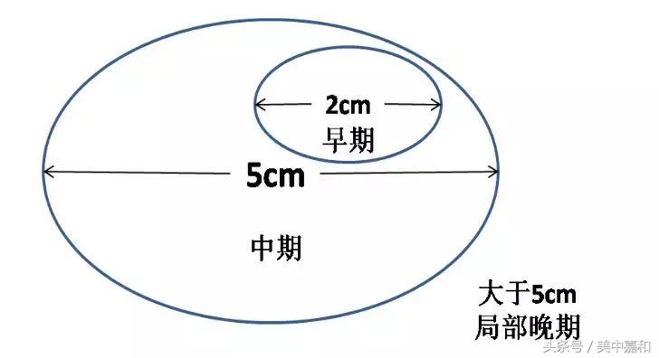 只要“抓住”这七点，轻松看懂乳腺癌病理报告单