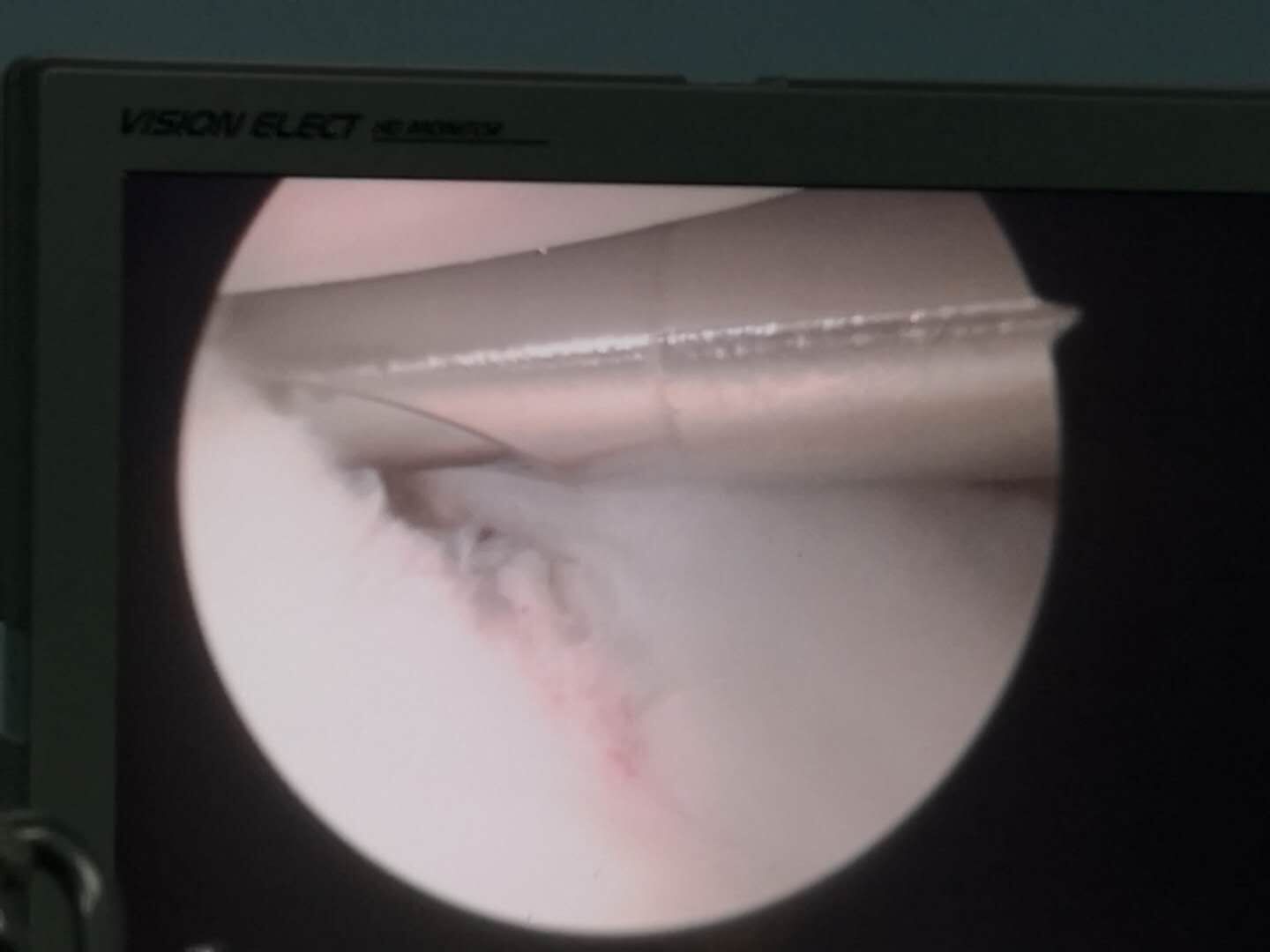 肩关节习惯性脱臼球员,肩关节习惯性脱位能恢复到原来吗