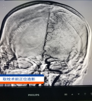 兰州石化总医院卒中中心成功救治一名昏迷脑卒中患者