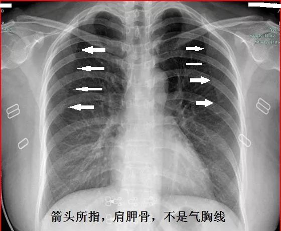 这样的气胸不少见,胸腔穿刺需谨慎!