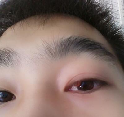 小孩子麦粒肿一般多少天自愈,孩子麦粒肿一般多久自愈