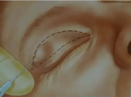 双眼皮是怎么搞的,双眼皮是怎么弄出来的