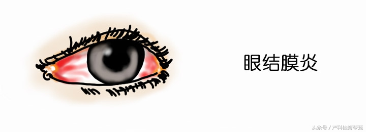 沙眼衣原体感染尿道症状,生殖器沙眼衣原体感染怎么治疗