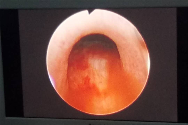 前列腺增生经尿道微创电切手术,前列腺增生加膀胱结石微创手术