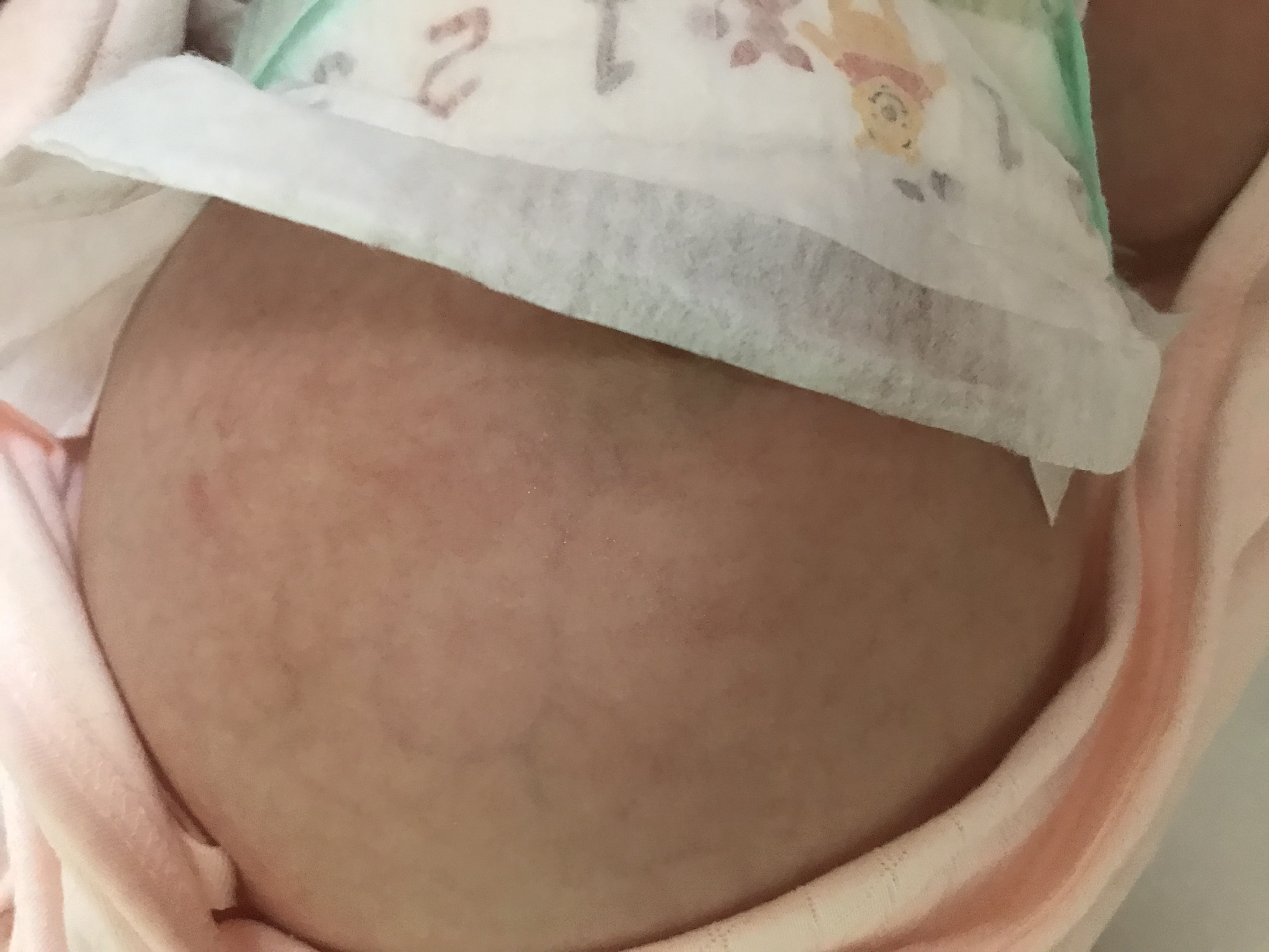 宝宝腹胀如鼓,儿童结肠胀气的症状及治疗