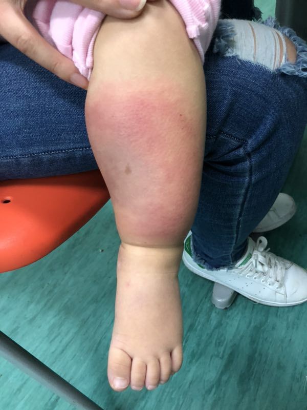 蚊虫咬了小宝宝,蚊虫咬了儿童用什么药