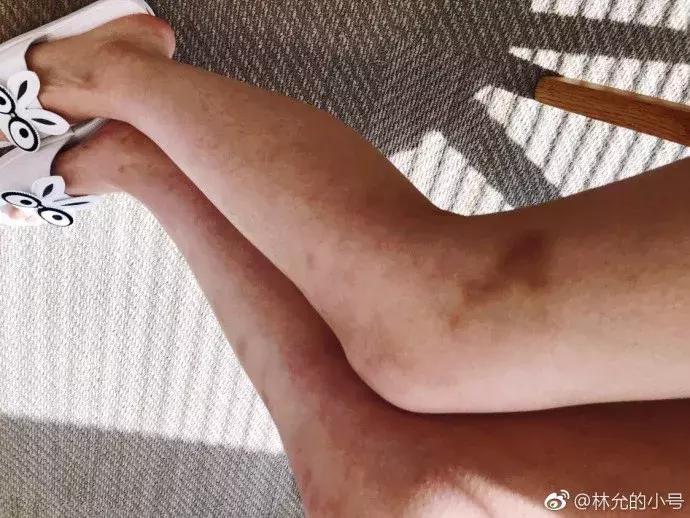 林允暴瘦照片,林允腿上的淤青原因