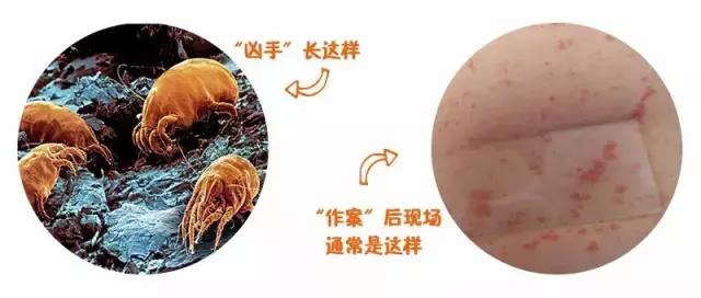 宝宝被蚊虫叮咬最好的解决办法,宝宝被蚊虫叮咬后有什么好办法吗