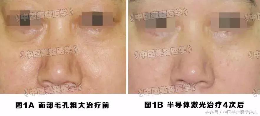 毛孔粗大修复小妙招不要护肤品,毛孔粗大怎么修复不花钱