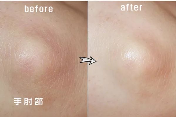 擦掉一块皮用什么药,擦掉了一小块皮一般需要多久恢复