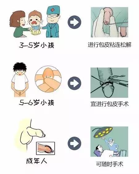 30岁做包皮手术做哪种最合适,30岁的男人适合做包皮手术吗