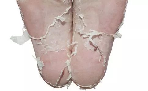 林允回应撕脚皮事件,林允撕脚皮用的是什么