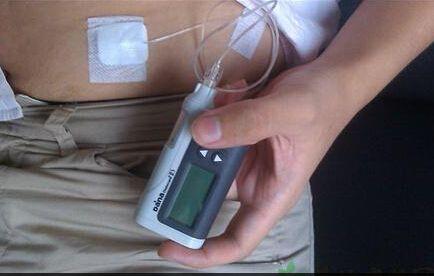 胰岛素泵多少钱一个能用几年,胰岛素泵多少钱一台用多久