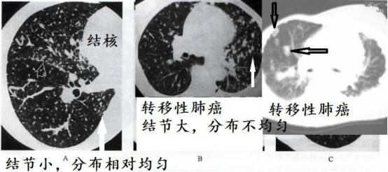 ct诊断肺癌肺结核,ct诊断出肺结核准确率高吗