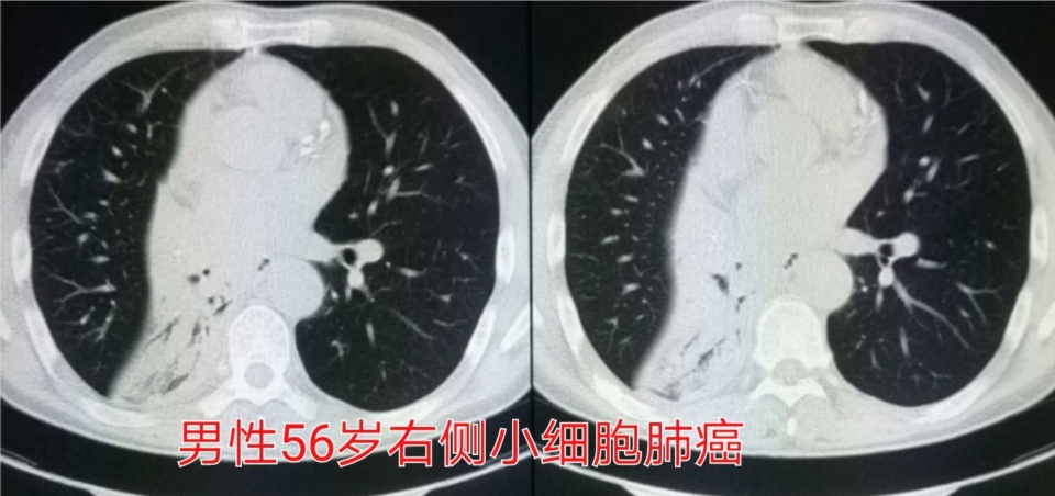 癌症靶向药治疗一年费用是多少,免疫加靶向治疗癌症几次能见效