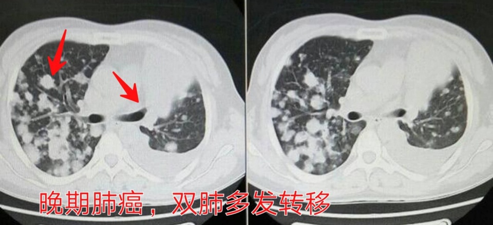 癌症靶向药治疗一年费用是多少,免疫加靶向治疗癌症几次能见效