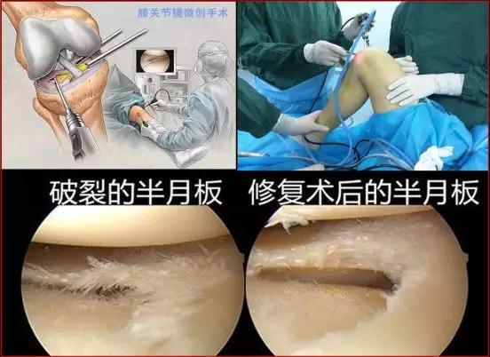 简述半月板损伤的病因及治疗,半月板损伤症状健康科普
