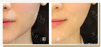 顽固性易胖体质怎么瘦下去,145斤易胖体质能瘦下来吗