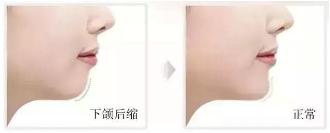 歪瓜裂枣好不好,歪瓜裂枣的牙齿好矫正吗