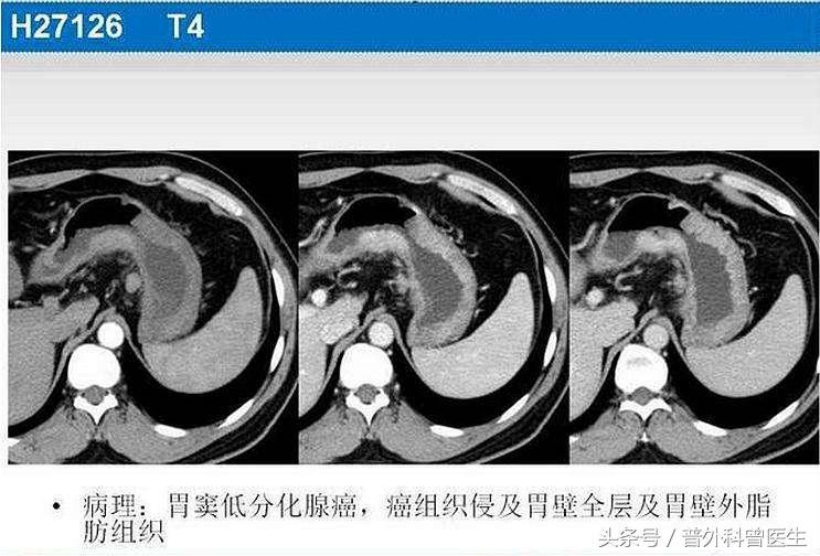 做胃镜没问题为什么胃还是不舒服,胃不舒服是喝钡餐检查还是做胃镜