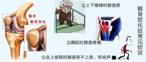 髌骨软骨软化的康复方法