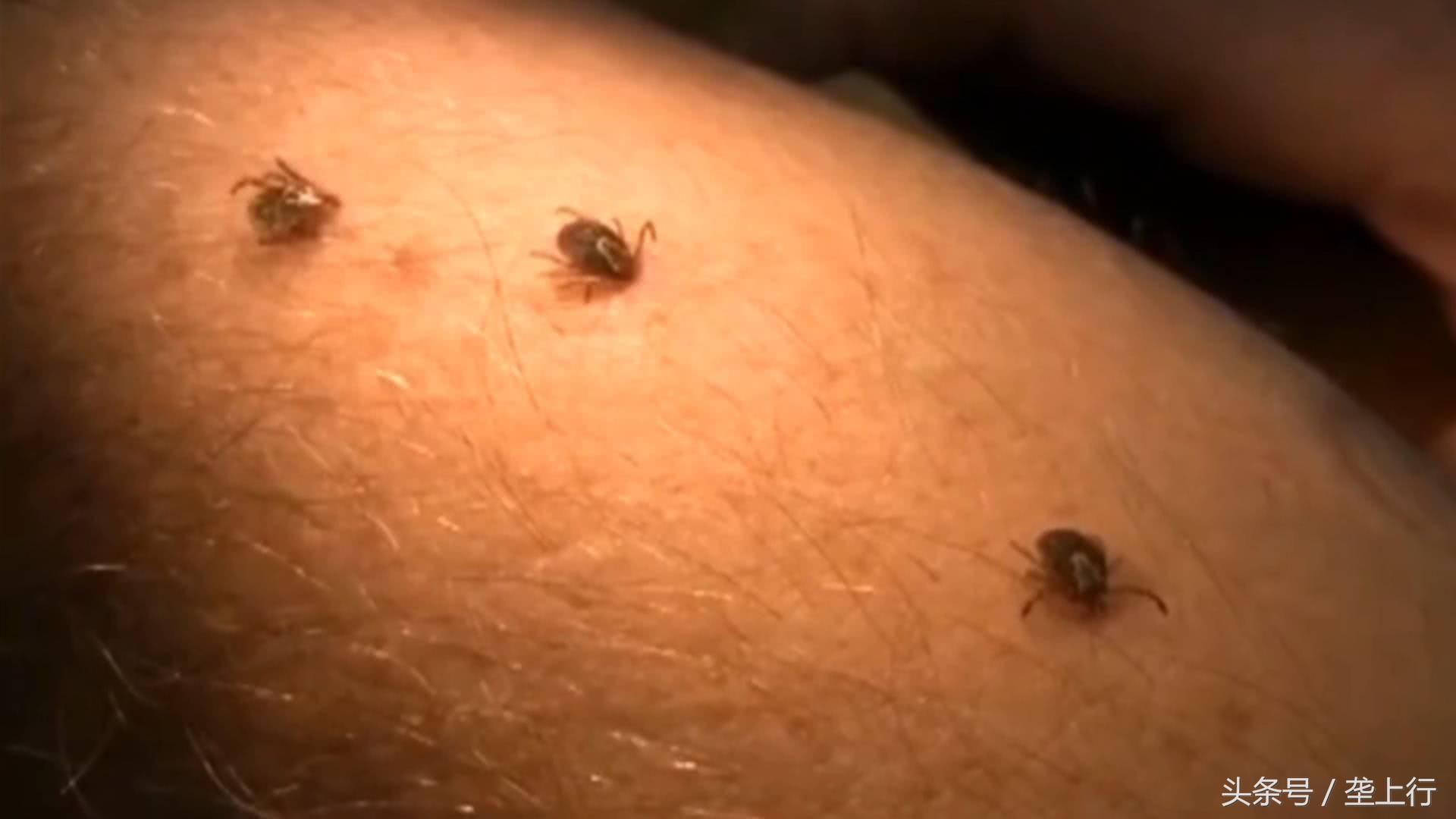 蜱虫叮咬发病有什么后果,蜱虫咬伤症状