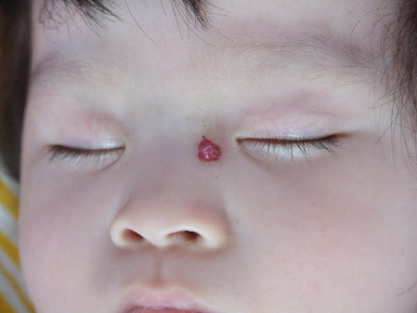 长红痣身体的哪些部位是最好的,身上有红痣越来越大是什么原因