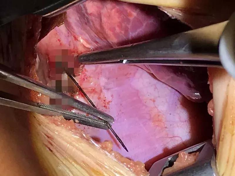 一岁的宝宝胸腔都高吗,一岁半的宝宝胸腔有点高