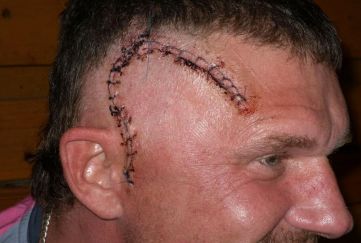 细胞免疫治疗肿瘤什么时间推行的,细胞免疫治疗学