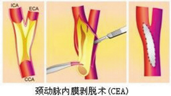 颈动脉狭窄引起头晕麻木吃什么,莫名头晕眼前发黑警惕颈动脉狭窄