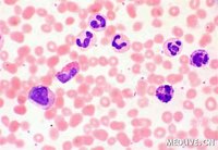 慢性白血病格列卫,慢性粒细胞白血病格列卫