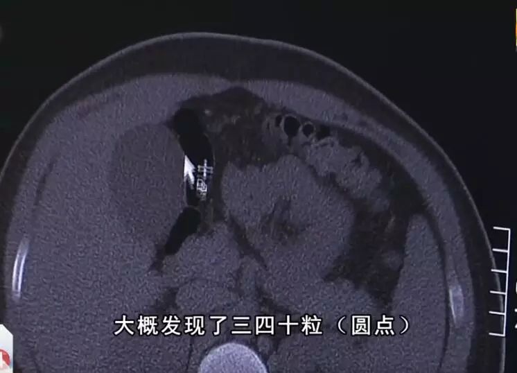 男孩喝完珍珠奶茶胃里全是珍珠,13岁男孩喝珍珠奶茶引发的案例