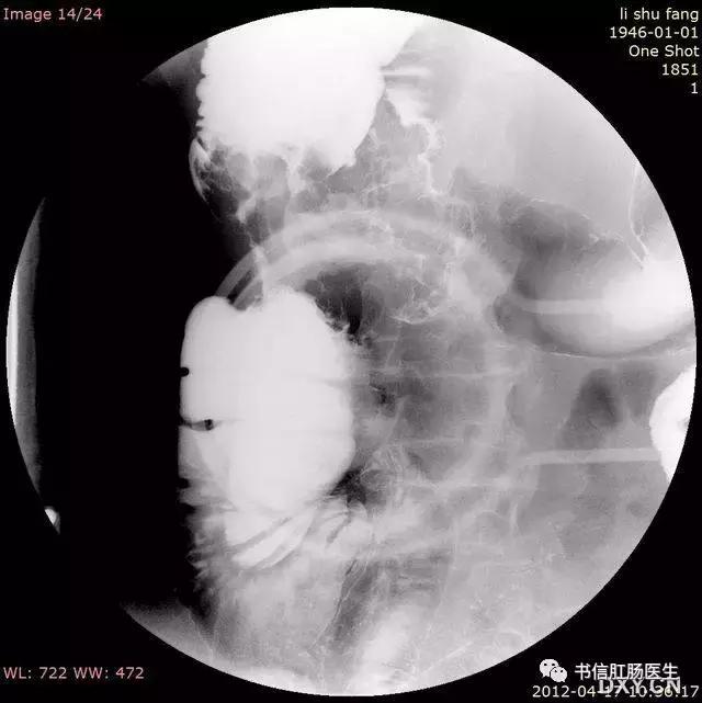 10种经典肠道影像征象详解
