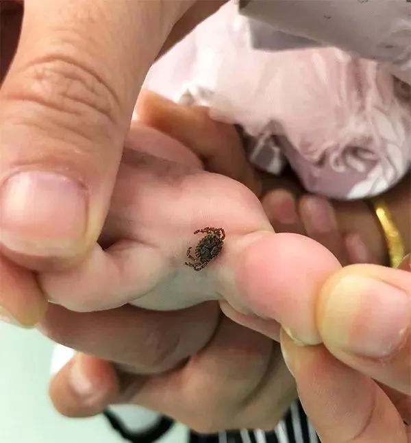 小心“新型艾滋病”，虫子就能传播