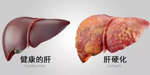 脂肪长在肝上意味着什么,脂肪不长要做手术