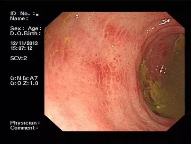 缺血性结肠炎内镜图片,缺血性肠炎肠镜表现