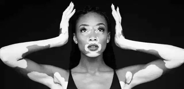 直播治疗白癜风最新特效药,白癜风治疗视频直播