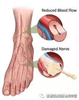 「杏林微科普」暴雨天，外出蹚水淋雨，小心得了脉管炎！