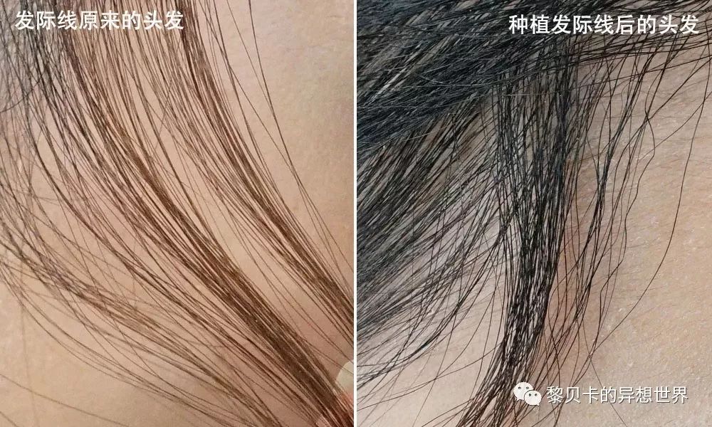 揭秘种植发际线,发际线种植真实体验